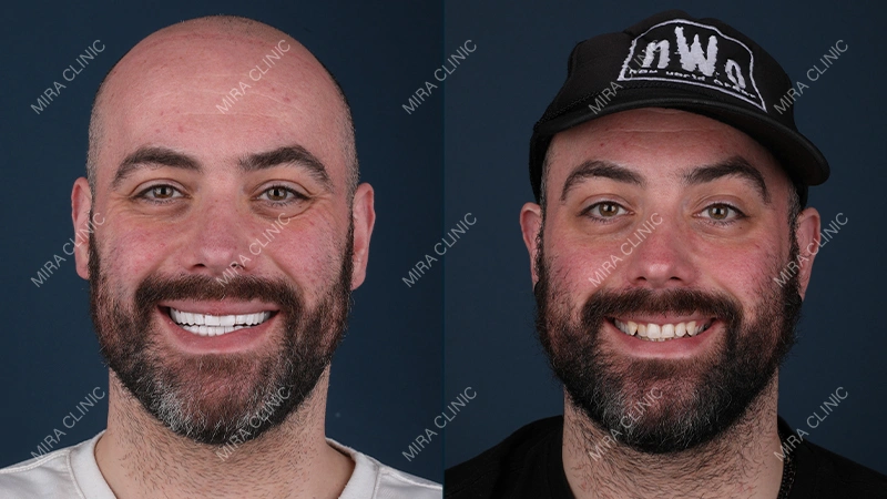 Before and After zirconium crown installation